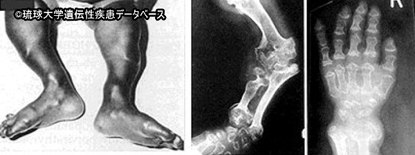 変容性骨異形成症患者の手足で見られる関節の拘縮や短縮化