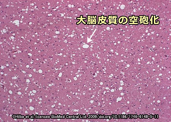 ネコ海綿状脳症（FSE）により大脳皮質に生じた空砲化