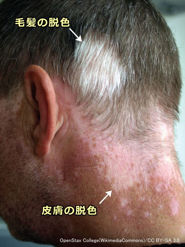 人間の尋常性白斑は皮膚や被毛からの色素脱落という形で発症する