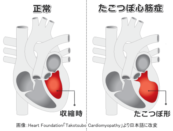 たこつぼ心筋症の模式図～収縮時の左心室がたこつぼに見えるのが由来