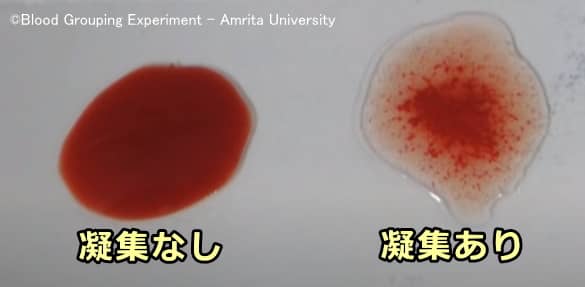 抗体によって凝集反応を起こした赤血球は固まって毛細血管を通れなくなる