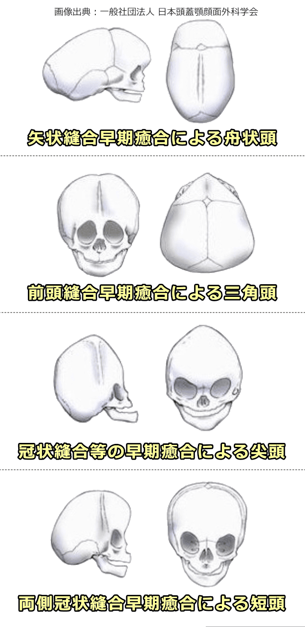 頭蓋縫合早期癒合症のタイプと外見一覧