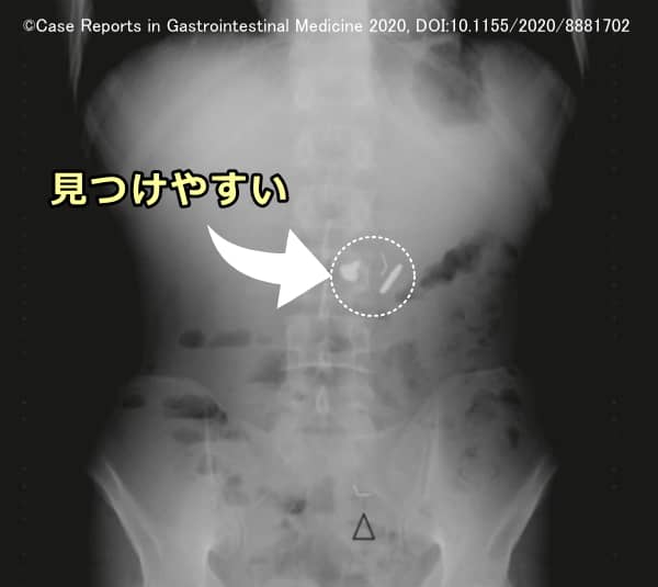 不透過性の高い異物はエックス線で視認しやすい