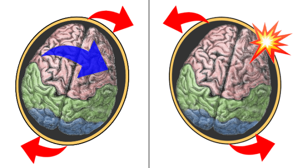 脳内におけるびまん性軸索損傷の発症メカニズム